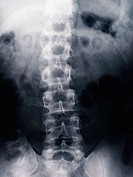 Human being. Skeleton, spine with scoliosis