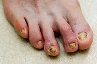 Toenails infected with fungus.
