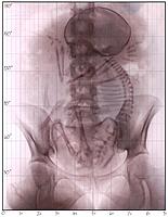 X-Ray of fetus