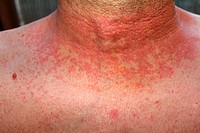 dermititis should be dermatitisRed skin rash on a man´s neck and chest due to scarlet fever, fever, dermatitis or eczema