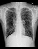 Chest X-ray of a 28 year old male patient suffering from Dyspnea due to Cystic Fibrosis and drug induced Osteoporosis