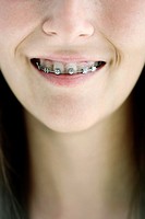 Girl with irons on teeth