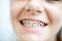 ortodoncia, primer plano de boca de chica adolescente con aparatos en los dientes, Orthodontics, mouth foreground teenage girl with braces on teeth,