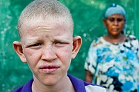 Albino boy with his mother ( Ethiopia).