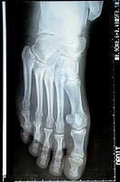 X-ray image of a mature woman's foot.
