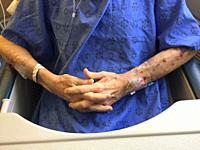 An elderly man with multiple IVs in his arms, keeps his fingers crossed in a hospital setting, Ontario, Canada.