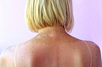 Sunburn from beach sun light on shoulder and back of caucacian girl. Woman sunburn. Female body. Body care.