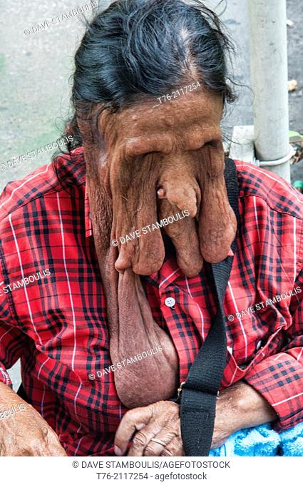 beggar with elephantiasis in Bangkok, Thailand