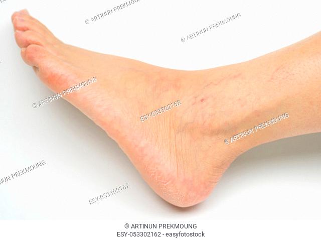 Closeup cracked heels and varicose veins on Asian woman leg and ankle isolated on white background with copy space. The problem from wearing high heels