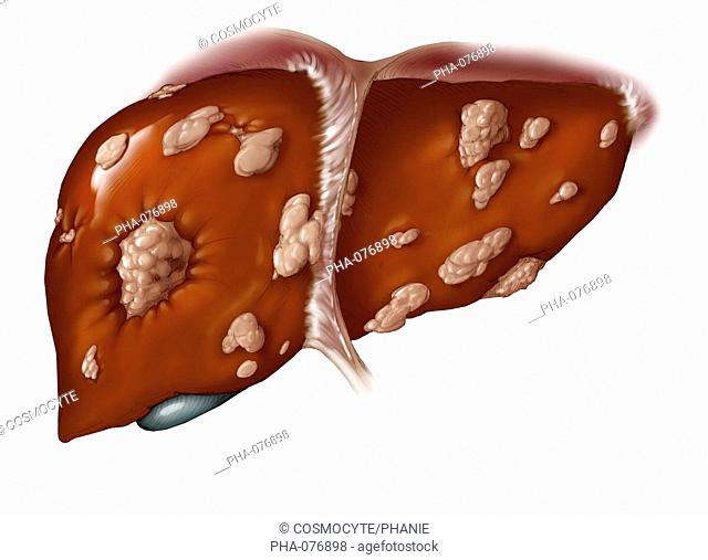 Artwork of cancerous liver. Tumors appear in white