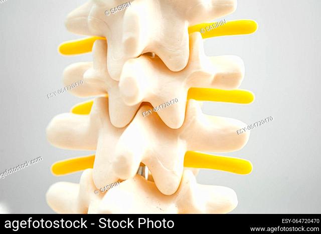 Lumbar spine displaced herniated disc fragment, spinal nerve and bone. Model for treatment medical in the orthopedic department