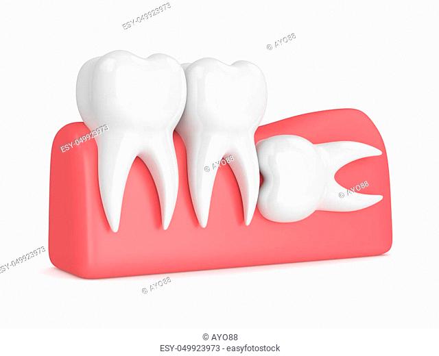 3d render of teeth with wisdom horizontal impaction over white background. Concept of different types of wisdom teeth impactions