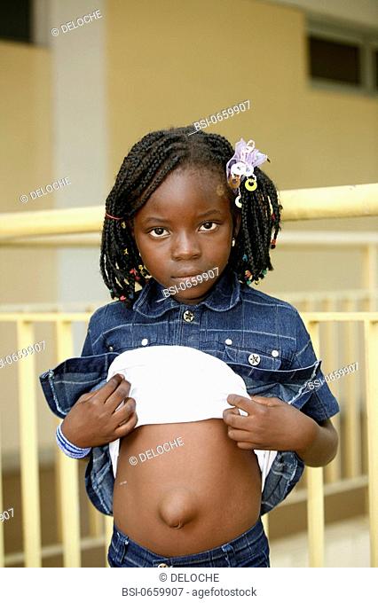 UMBILICAL HERNIA Photo essay in a hospital in Congo Chain of Hope. Girl with a umbilical hernia. The umbilical hernia corresponds to a protuberence from a...