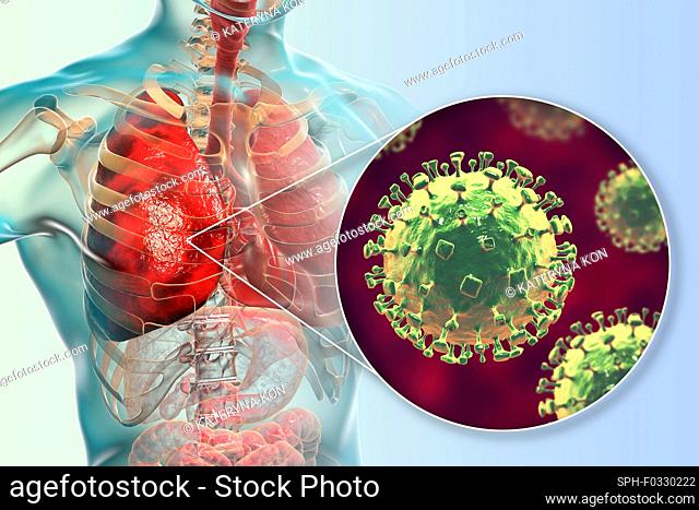 Nipah virus in lungs, illustration