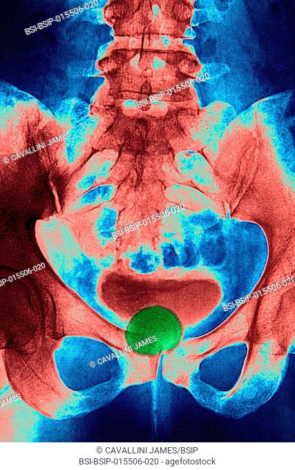 Diverticulum in the bladder. Frontal pelvic x-ray