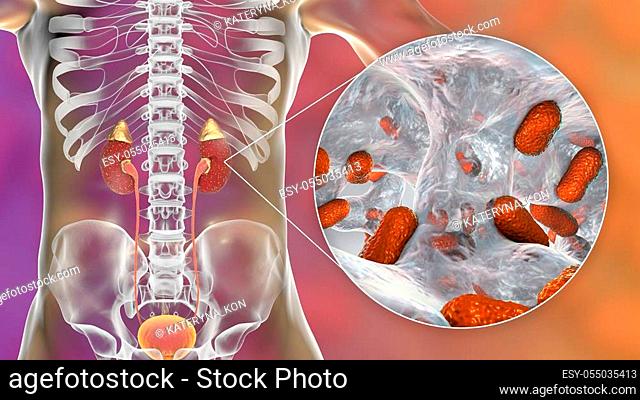 Acute pyelonephritis caused by bacteria Acinetobacter baumannii, medical concept, 3D illustration