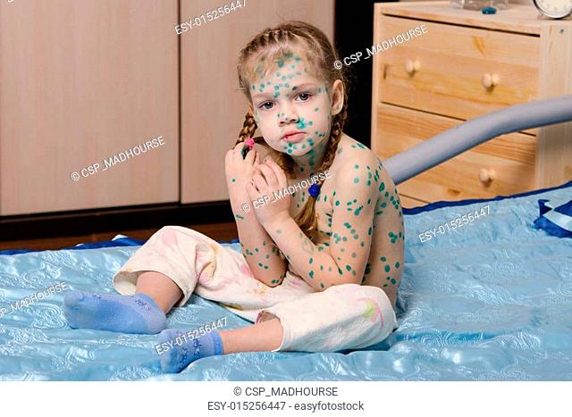 Little girl covered with green traces of chickenpox sitting on bed
