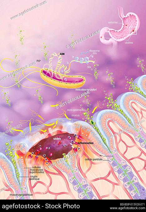 Ulceration of the gastric mucosa with Helicobacter pylori, and treatments. Zoom on the gastric mucosa seen in section. On the left