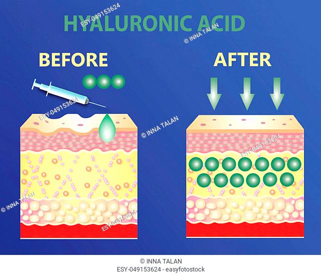 Hyaluronic acid. skin-care products. skin rejuvenation with help of hyaluronic acid. Lifting by filler concept