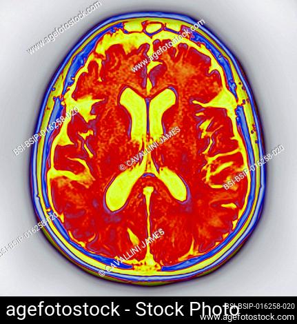 Cerebral atrophy - Bilateral cortical and subcortical temporal atrophy (frontotemporal degeneration responsible for neurodegenerative diseases including...