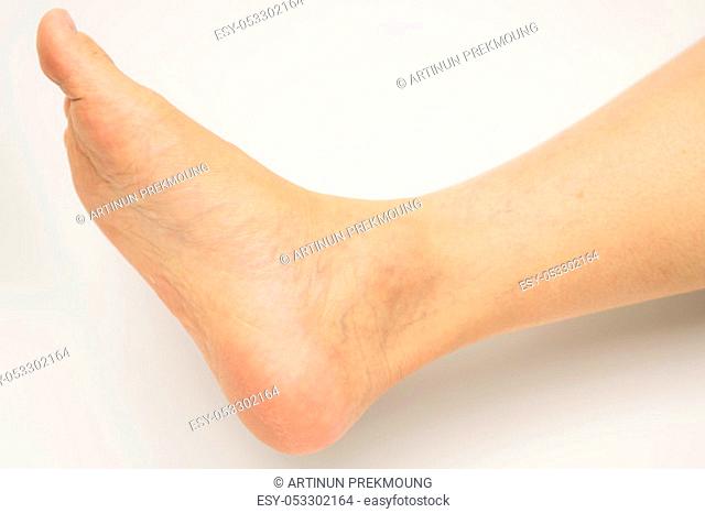Closeup cracked heels and varicose veins on Asian woman leg and ankle isolated on white background with copy space. The problem from wearing high heels
