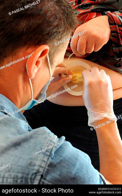 Self-employed country nurse at the home of a patient with stomach cancer. Repair of a jejunostomy dressing equipped with a feeding tube placed in the jejunum