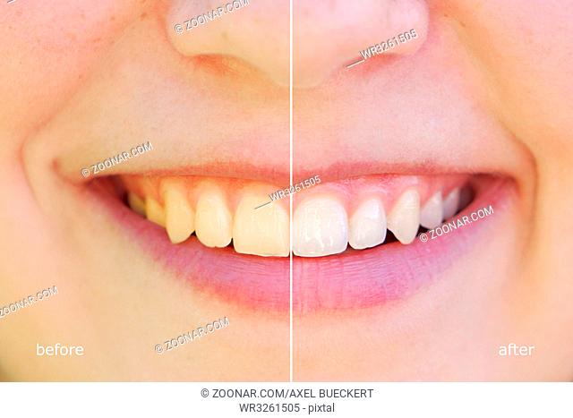 teeth whitening before and after concept. comparison between yellow and white teeth side by side