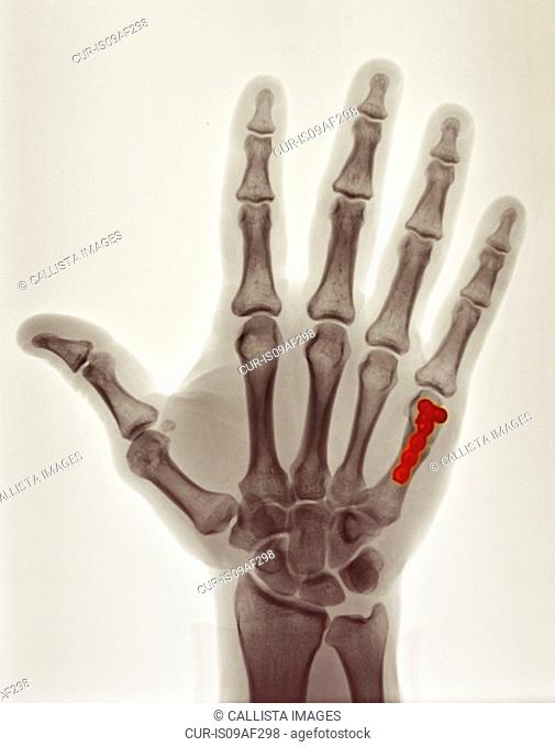 colorized x-ray showing repair of boxer's fracture