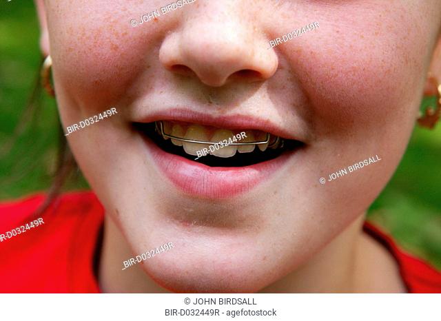 Close up of brace on a young girls teeth