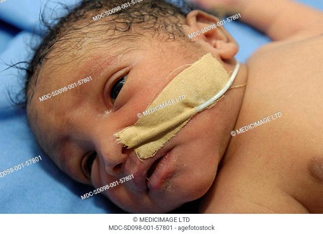 A close-up of a premature baby with an intravenous drip sleeping in an incubator. The drip will allow doctors and nurses to feed the baby various drugs without...