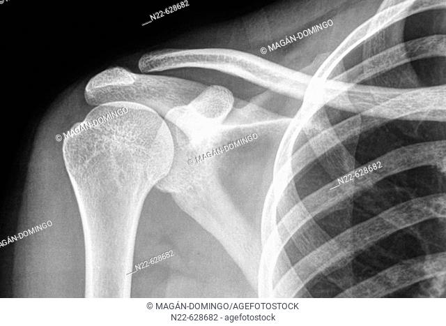 Shoulder bones X-rays