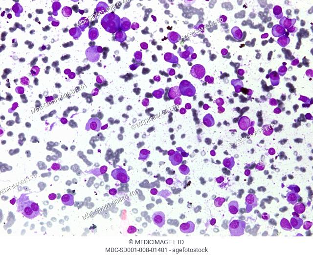 Microscopic image of Multiple Myeloma./n/nMultiple Myeloma is type of cancer, it occurs then a plasma cell becomes abnormal and cancerous