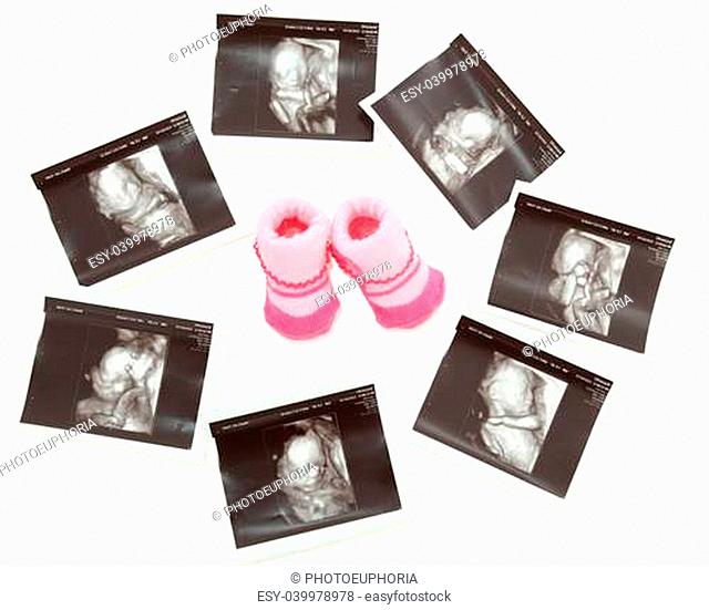 Group of 3D/4D Ultrasound images around a pair of pink baby booties