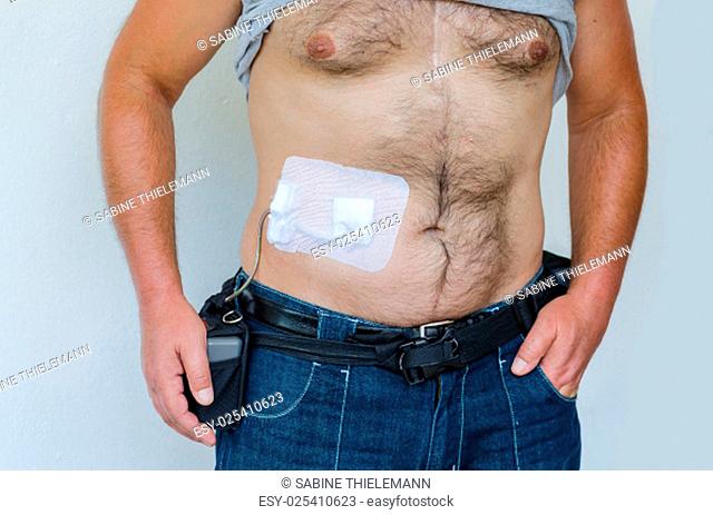 man with a support system, artificial heart, lvad, left or right ventricular assist device, control unit batteries and power cables