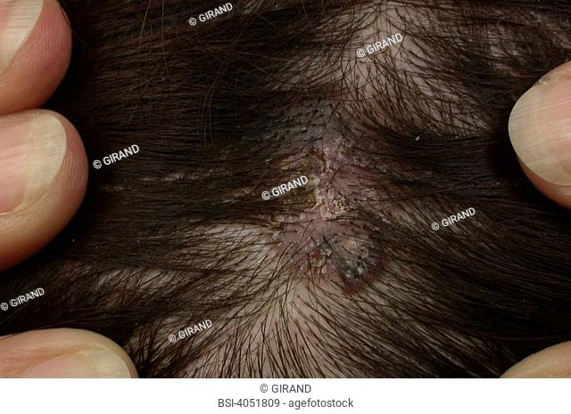 Basal Cell Carcinoma Carcinoma Scalp Stock Photos And Images