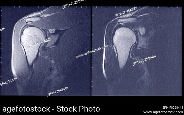 Shoulder joint, MRI