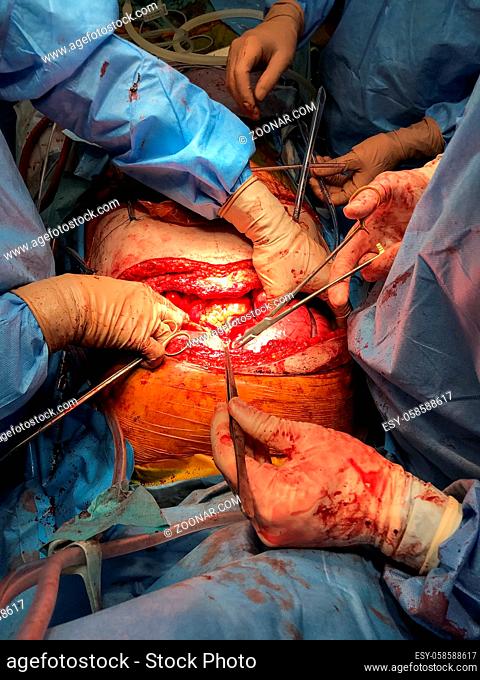 Close up of surgeon team performing real medical sternotomy, open chest, organ transplantation surgery on patient. Healthcare and medicine