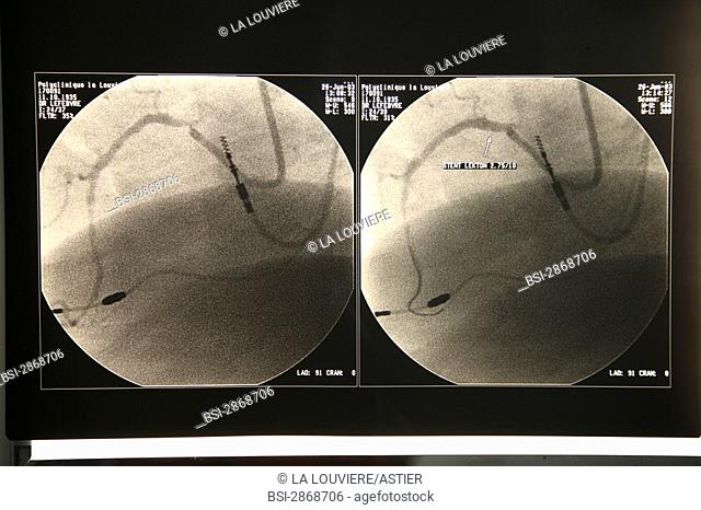 ARTERIAL ANGIOPLASTY, RESULT<BR>Photo essay from La Louvière clinic, France (59).<BR>Pictures with a lesion on the second segment of the right coronary artery...