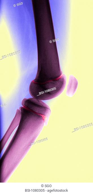 KNEE, X-RAY<BR>Epiphyseal cartilage of the femur and tibia, in light pink. This cartilage plays a vital role during bone growth