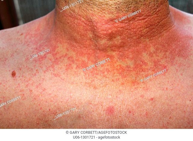 dermititis should be dermatitisRed skin rash on a man's neck and chest due to scarlet fever, fever, dermatitis or eczema