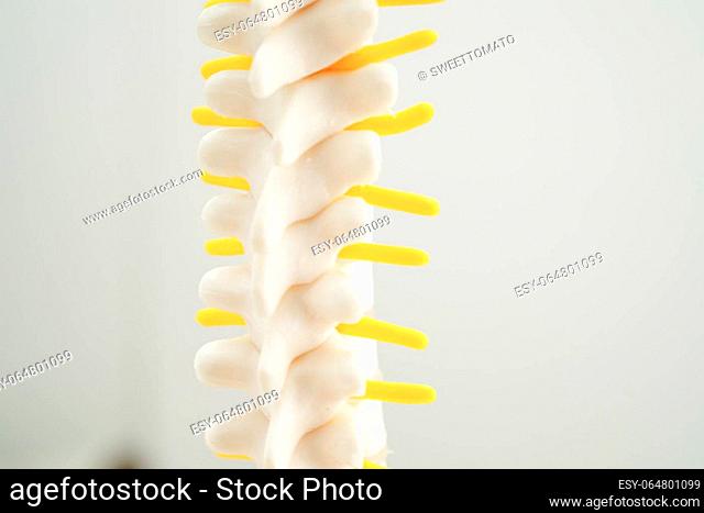 Spinal nerve and bone, Lumbar spine displaced herniated disc fragment, Model for treatment medical in the orthopedic department