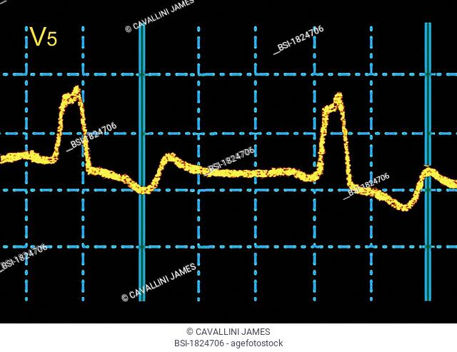 <BR> <BR>Incomplete bundle branch block: transmission of the electrical impulse is delayed or fails to conduct along the right or left branch of the His bundle