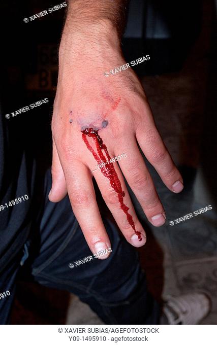 Injured hand (incidents in Barcelona -Catalonia, Spain- after the FC Barcelona soccer team victory in the Champions League, 2011)