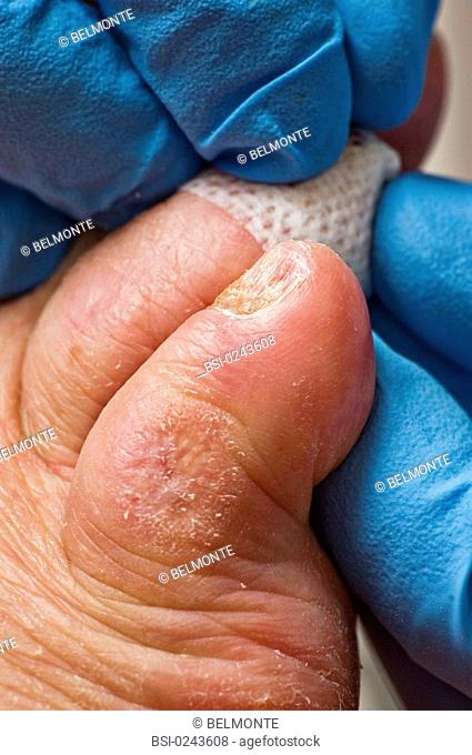 Photo essay from hospital. Pedicure care at the Corentin Celton hospital Issy-les-Moulineaux, France on a diabetic patient