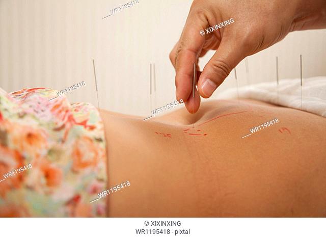 Inserting Acupuncture Needles