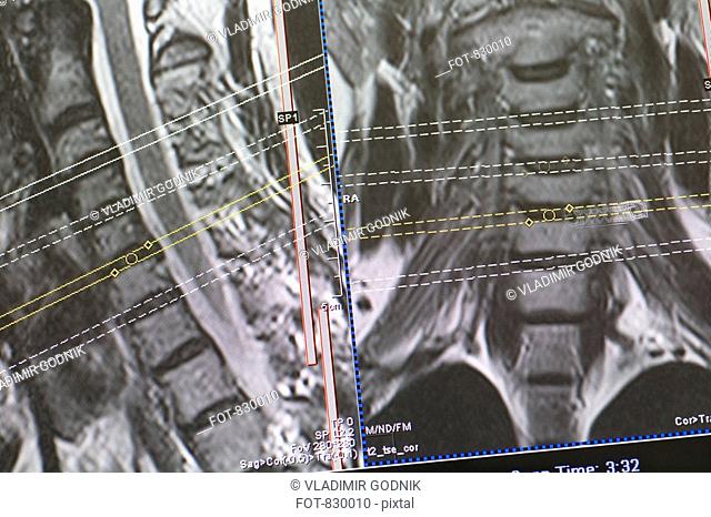 CAT Scan of the spine