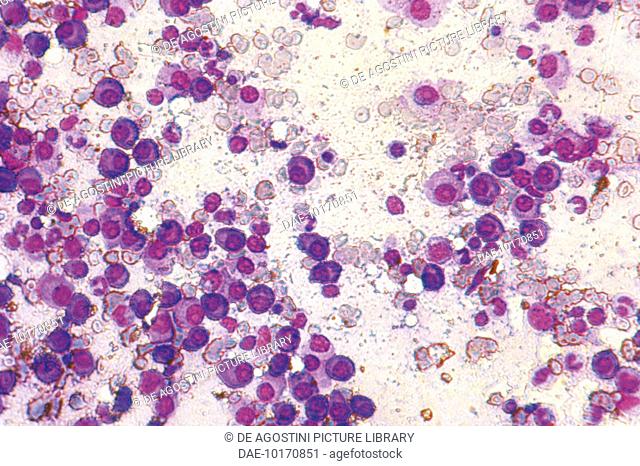 Section of bone marrow affected by myeloma seen under a microscope