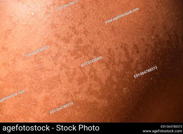 Sunburn on the skin of the shoulders. Exfoliation, skin peels off. Dangerous sun tan