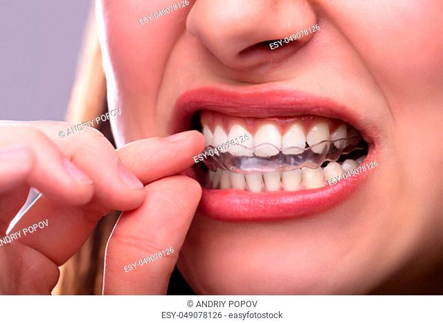 Close-up Of A Woman's Hand Putting Transparent Aligner In Teeth