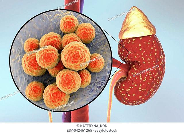 Pyelonephritis, medical concept, and close-up view of bacteria Staphylococcus, the common causative agent of kidney infection, 3D illustration